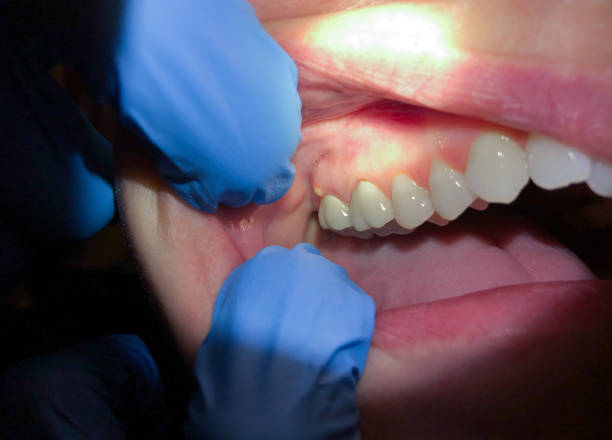 Best Dental Abscess Treatment in Sandersville, GA