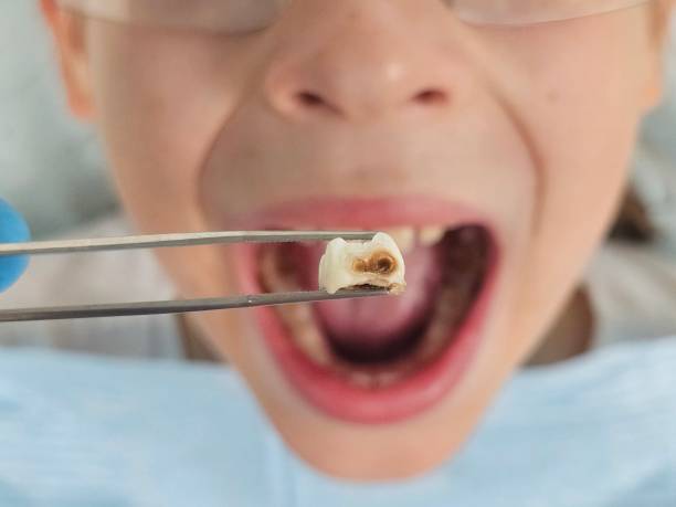 Best Broken or Chipped Tooth Repair in Sandersville, GA
