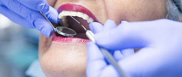 Best Knocked-Out Tooth (Avulsed Tooth) Treatment in Sandersville, GA